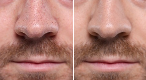 Image of Blackhead treatment, before and after. Collage with photos of man, closeup view