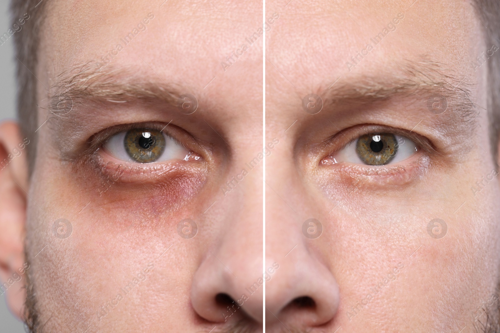 Image of Collage with photos of man with dark circle under eye before and after treatment on beige background, closeup