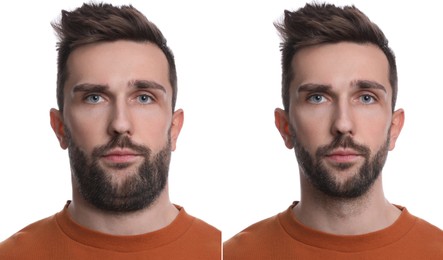 Image of Double chin problem. Collage with photos of man before and after plastic surgery procedure on white background