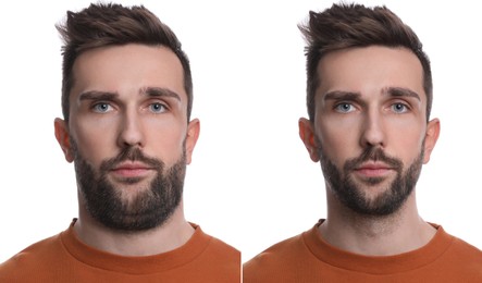 Double chin problem. Collage with photos of man before and after plastic surgery procedure on white background