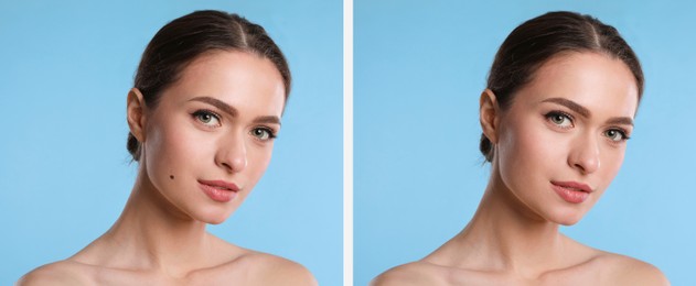 Image of Mole removal. Collage with photos of young woman before and after procedure on light blue background