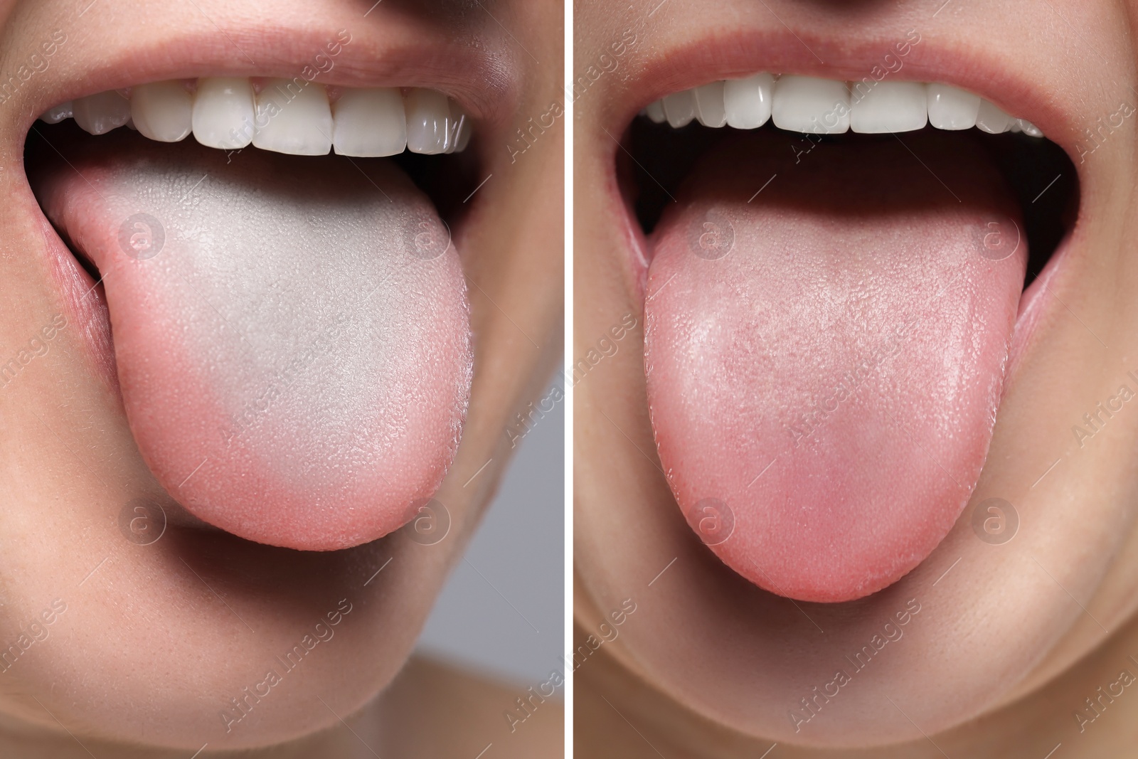 Image of Woman showing her tongue before and after cleaning procedure, closeup. Tongue coated with plaque on one side and healthy on other, collage