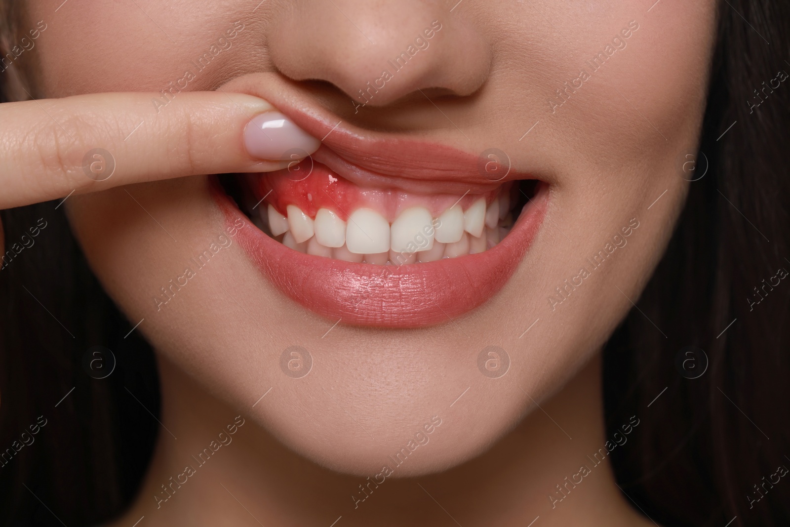 Image of Woman showing inflamed gum, closeup. Oral cavity health