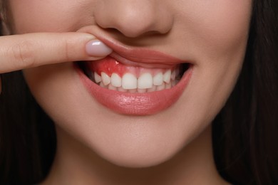 Woman showing inflamed gum, closeup. Oral cavity health