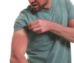 Man with sunburned skin on white background, closeup