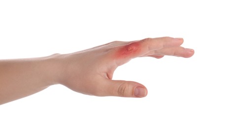 Photo of Woman with burn of her hand on white background, closeup