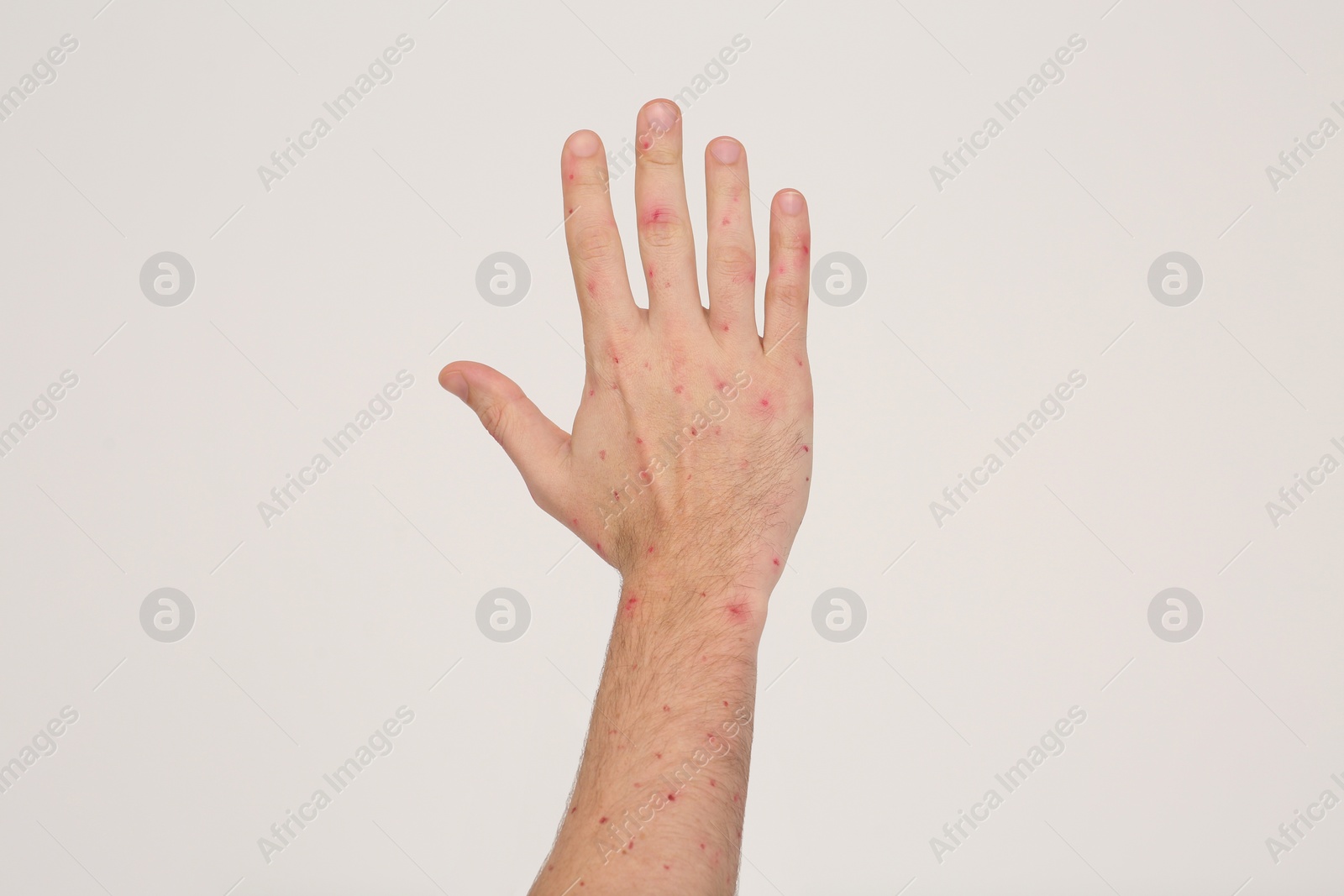 Photo of Man with rash suffering from monkeypox virus on beige background, closeup