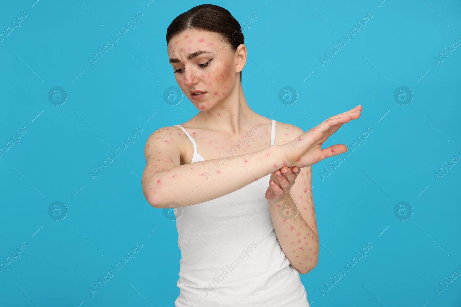 Photo of Woman with rash suffering from monkeypox virus on light blue background