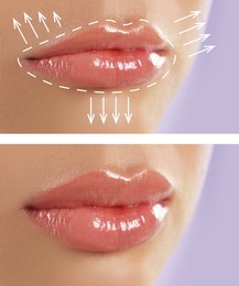 Collage with photos of young woman before and after lips augmentation procedure, closeup