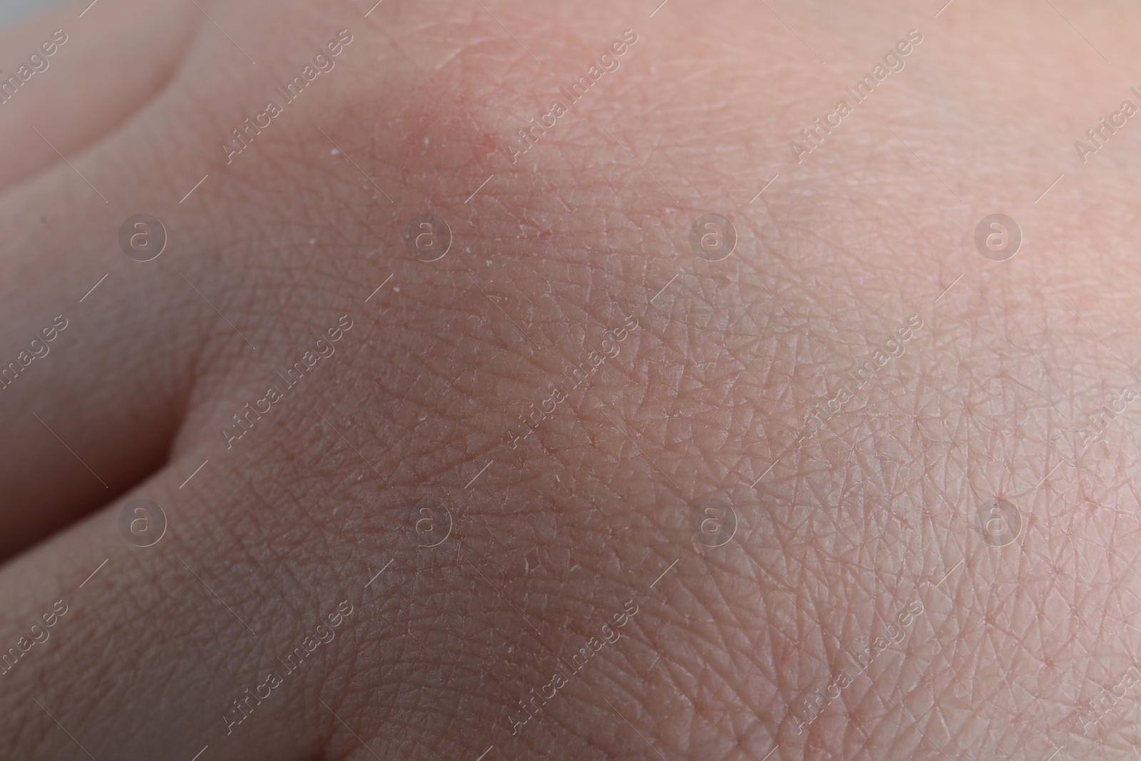 Photo of Woman with dry skin on hand, closeup