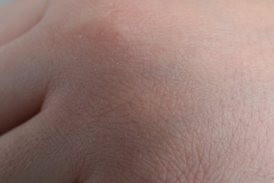 Woman with dry skin on hand, closeup