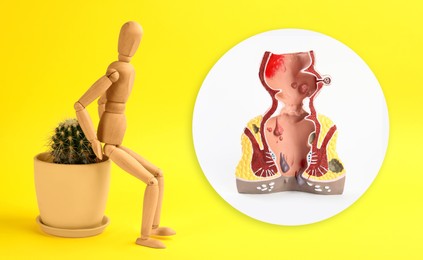 Image of Wooden human figure on cactus and anatomical model of rectum with hemorrhoids against yellow background 