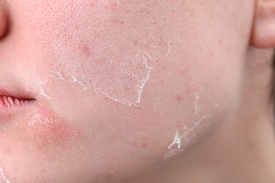 Photo of Woman with dry skin on face, closeup