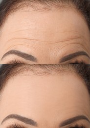 Woman before and after rejuvenating procedures. Collage with photos, closeup