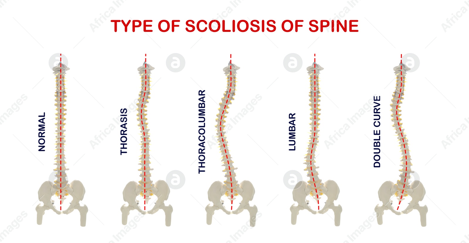 Illustration of Medical poster demonstrating types of scoliosis on white background.  healthy and diseased spine