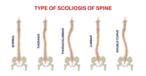 Illustration of Medical poster demonstrating types of scoliosis on white background.  healthy and diseased spine