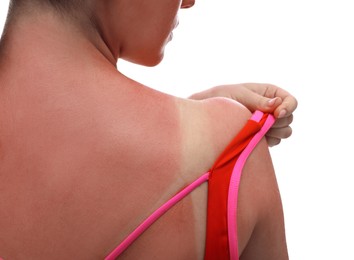 Woman with sunburned skin on white background, closeup