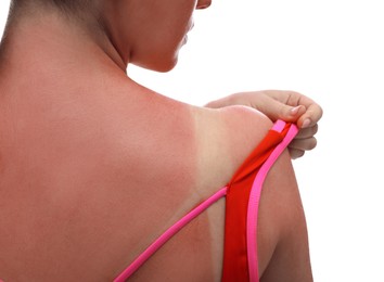 Photo of Woman with sunburned skin on white background, closeup