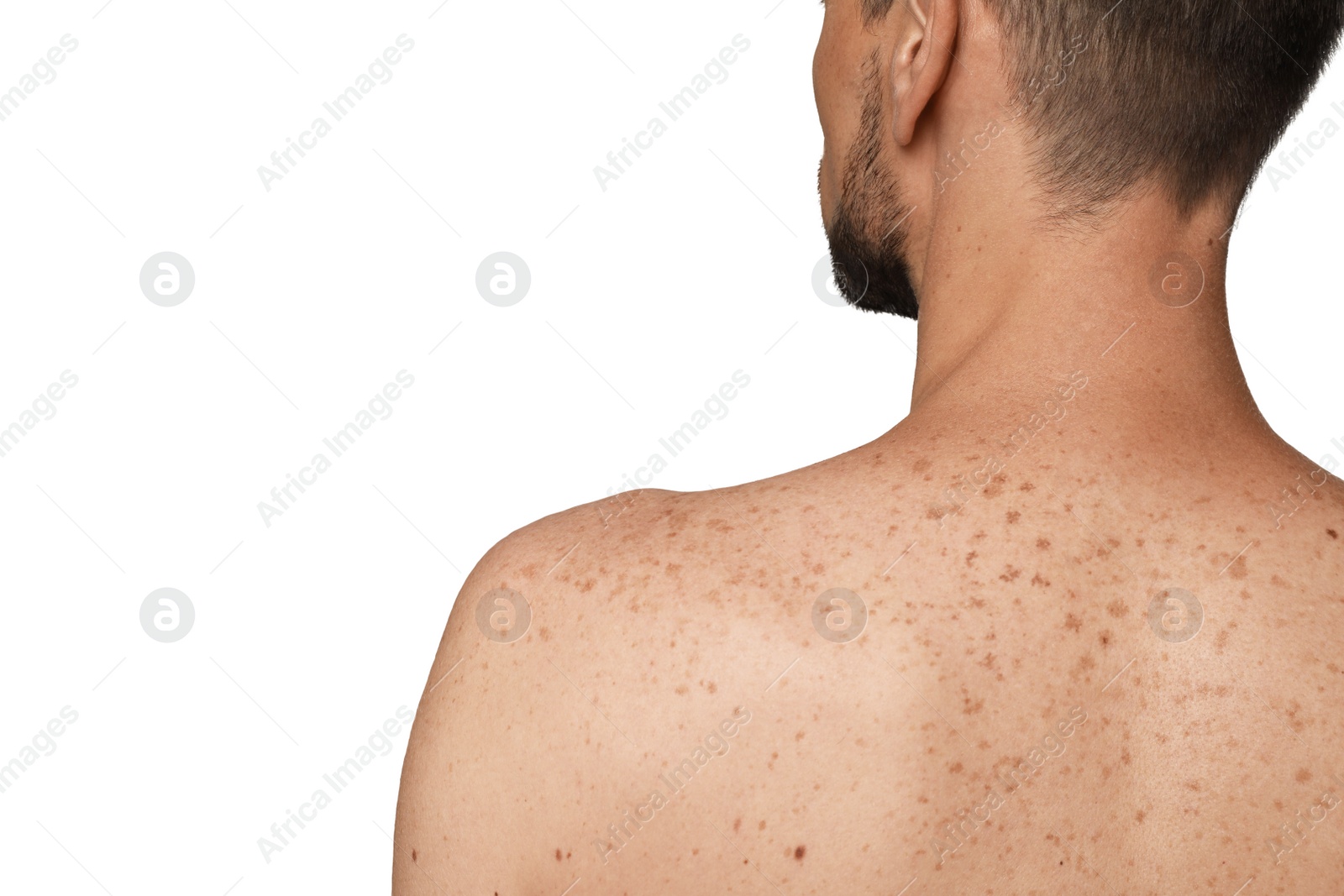 Photo of Closeup of man`s body with birthmarks on light grey background, back view. Space for text