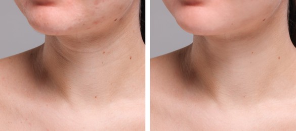 Aging skin changes. Woman showing neck before and after rejuvenation, closeup. Collage comparing skin condition