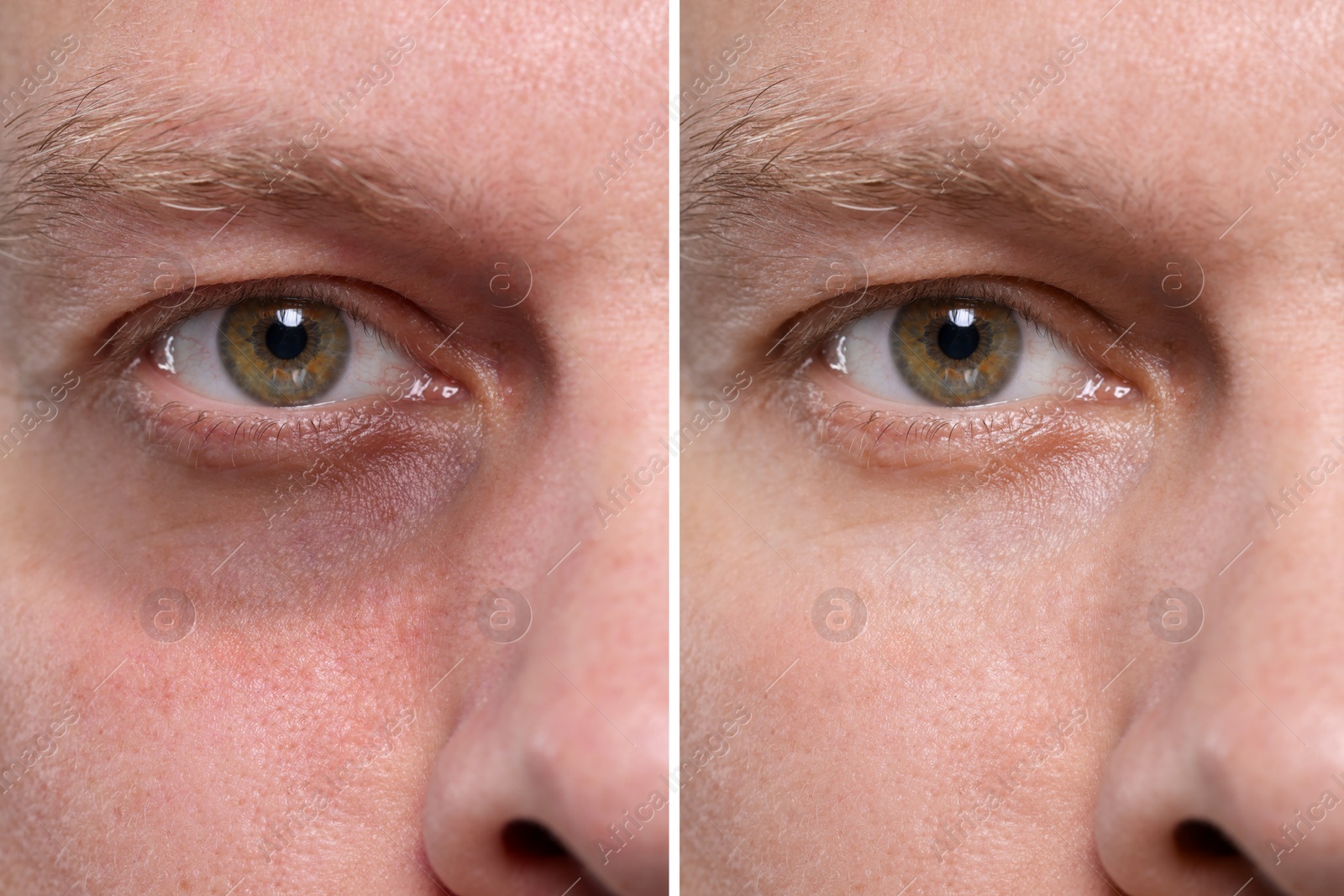 Image of Collage with photos of man with dark circle under eye before and after treatment, closeup