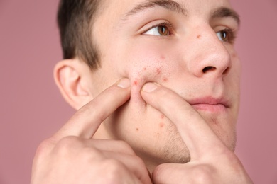 Young man squeezing acne on color background