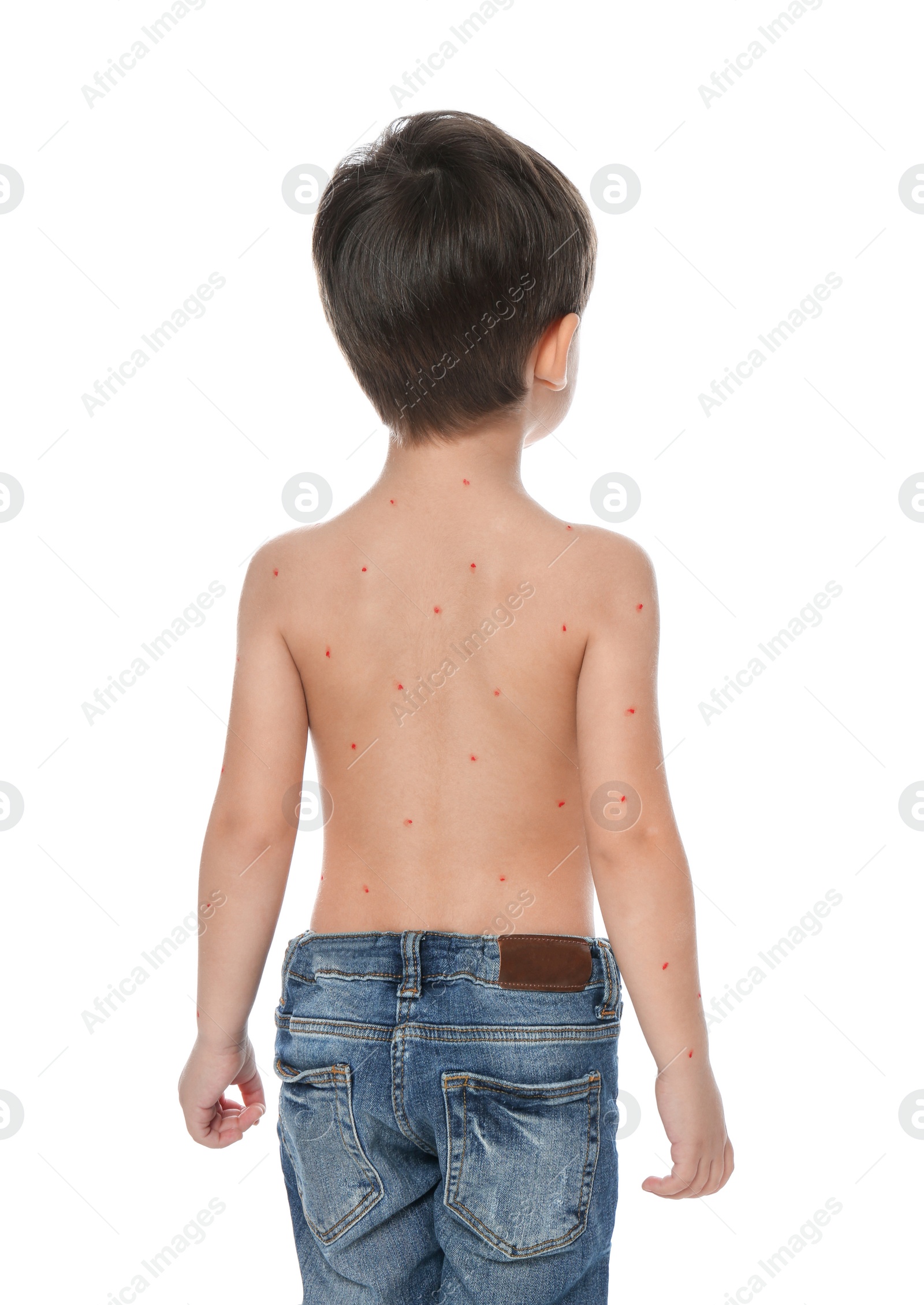 Photo of Little boy with chickenpox on white background. Varicella zoster virus