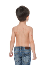 Photo of Little boy with chickenpox on white background. Varicella zoster virus