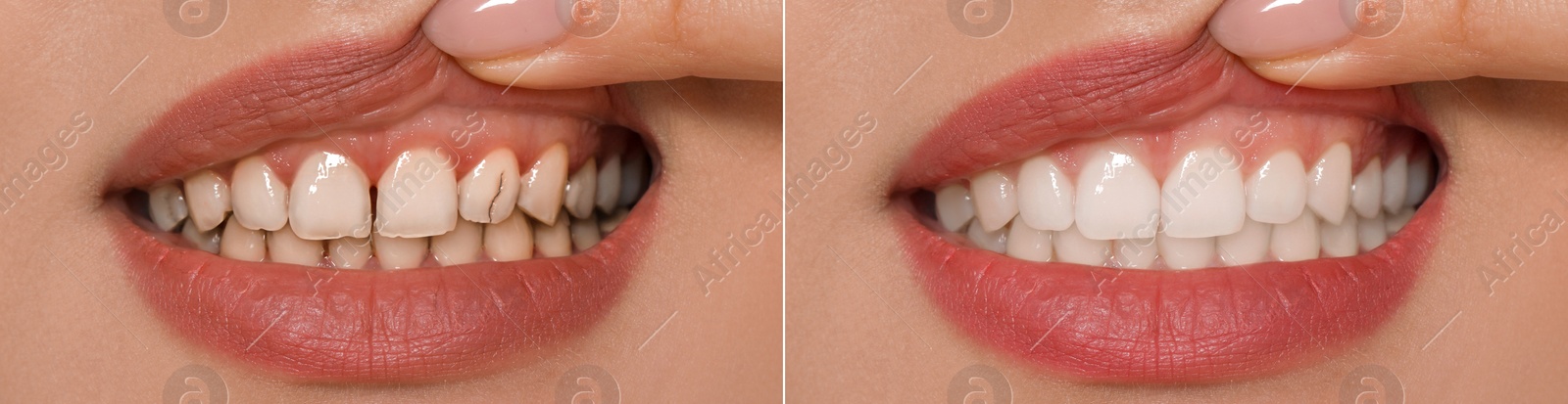 Image of Collage with photos of young woman before and after dental treatment, closeup. Banner design