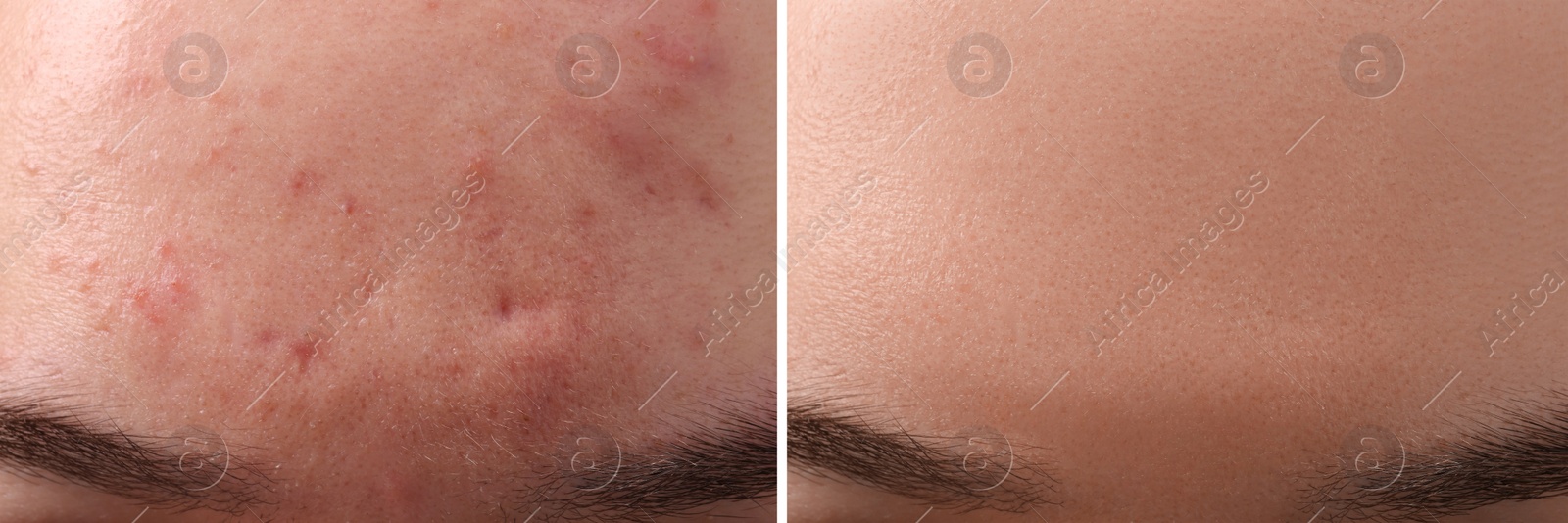 Image of Collage with photos of woman with acne problem before and after treatment, closeup. Banner design