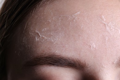 Woman with dry skin on forehead, macro view