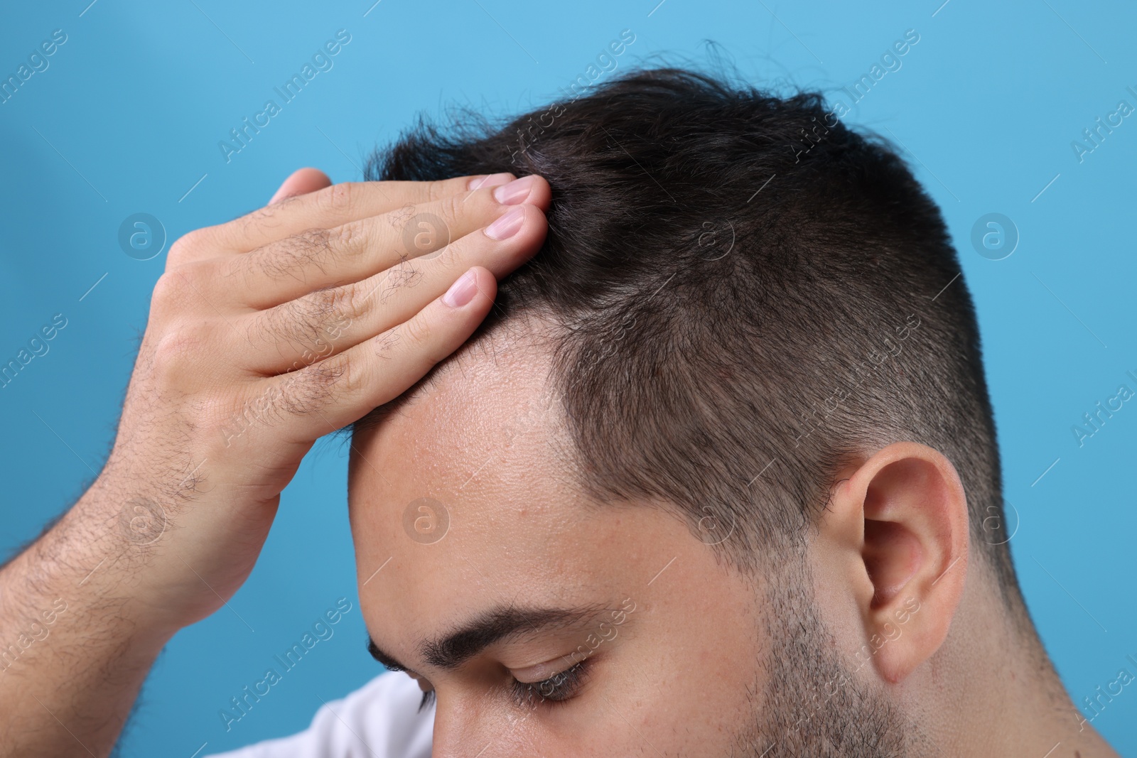 Photo of Man examining his head on light blue background, closeup. Dandruff problem