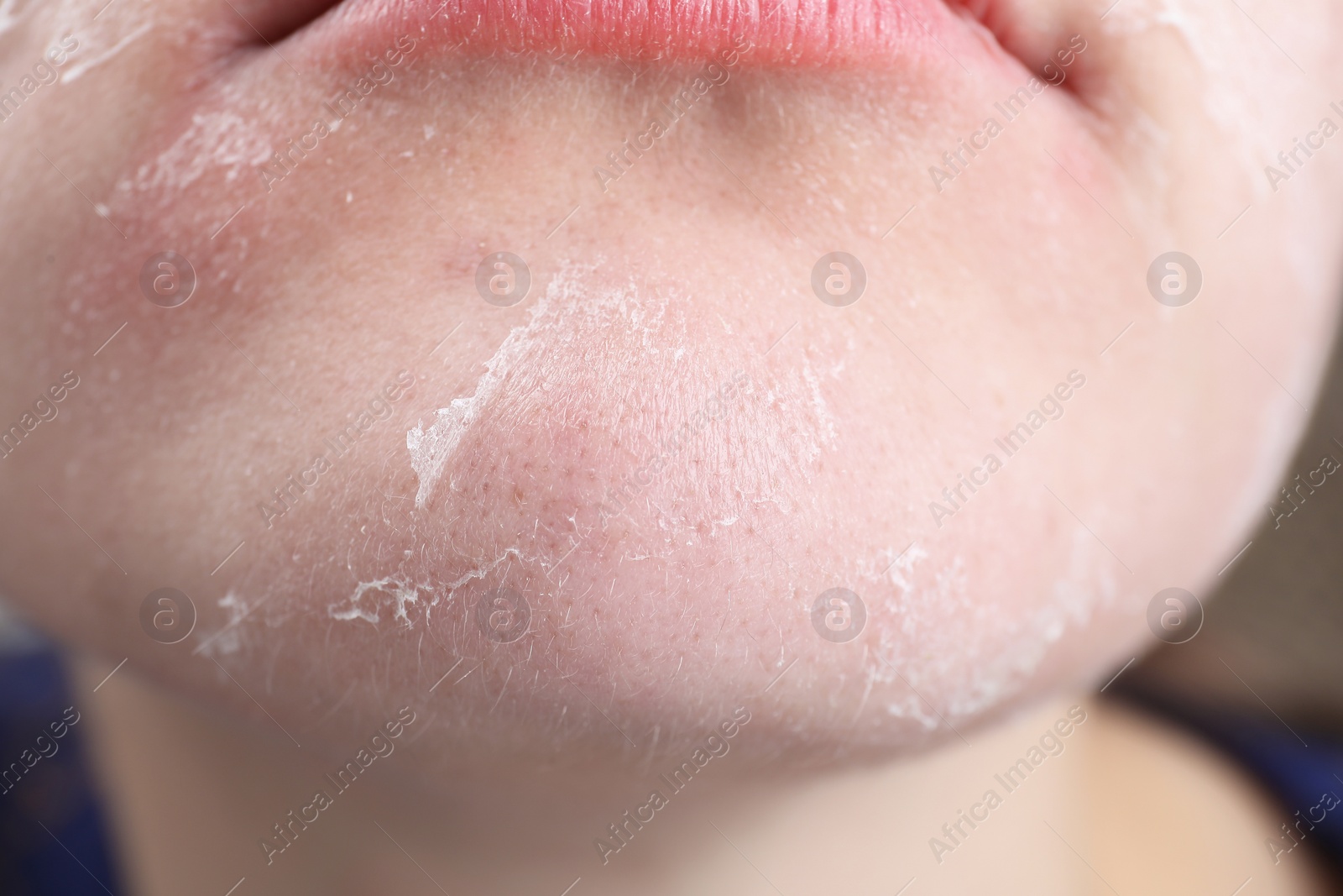 Photo of Woman with dry skin on face, closeup