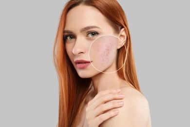 Image of Woman with acne on her face on grey background. Zoomed area showing problem skin