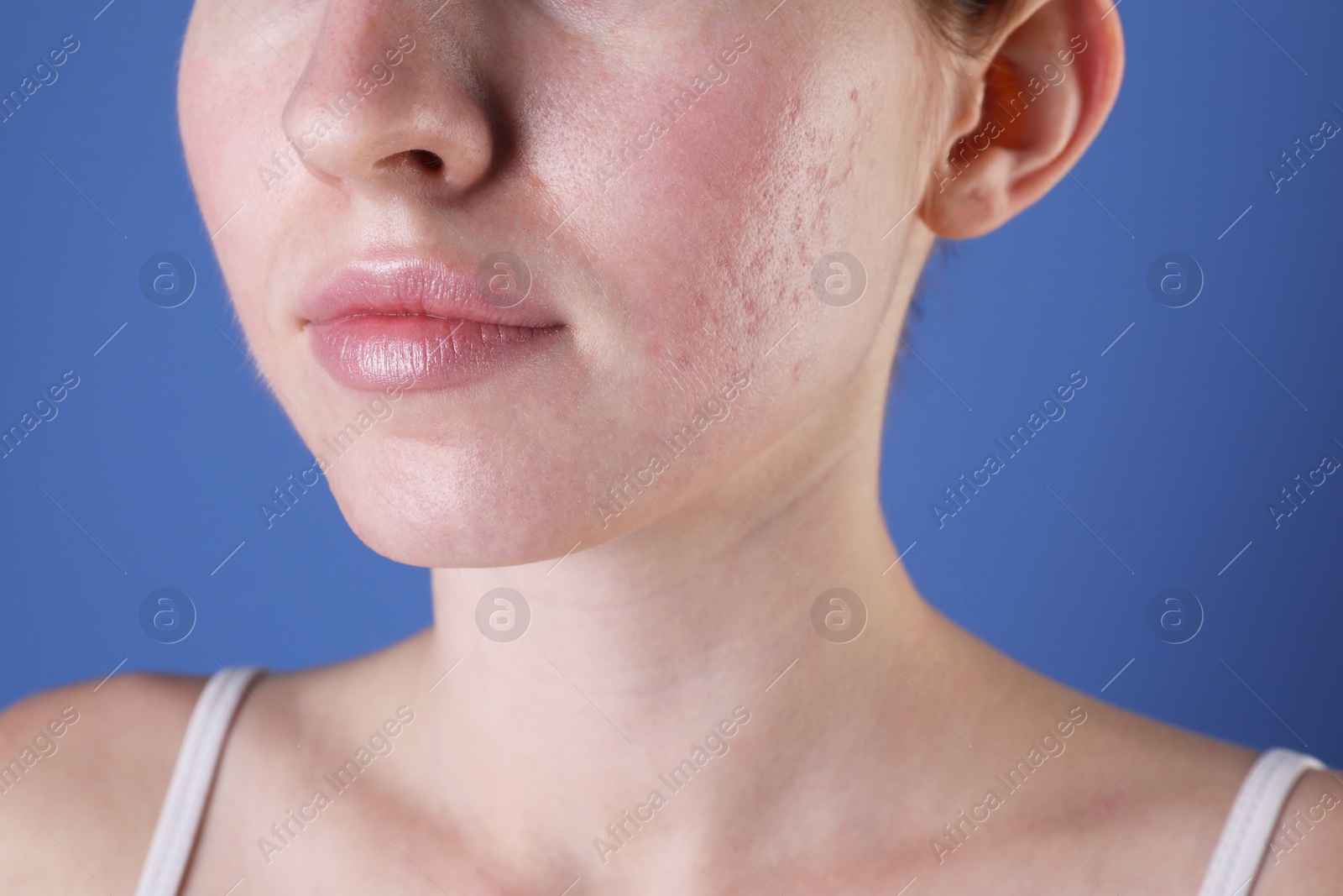 Photo of Young woman with acne problem on blue background, closeup