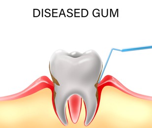 Infected gum and tooth, illustration. Periodontal disease