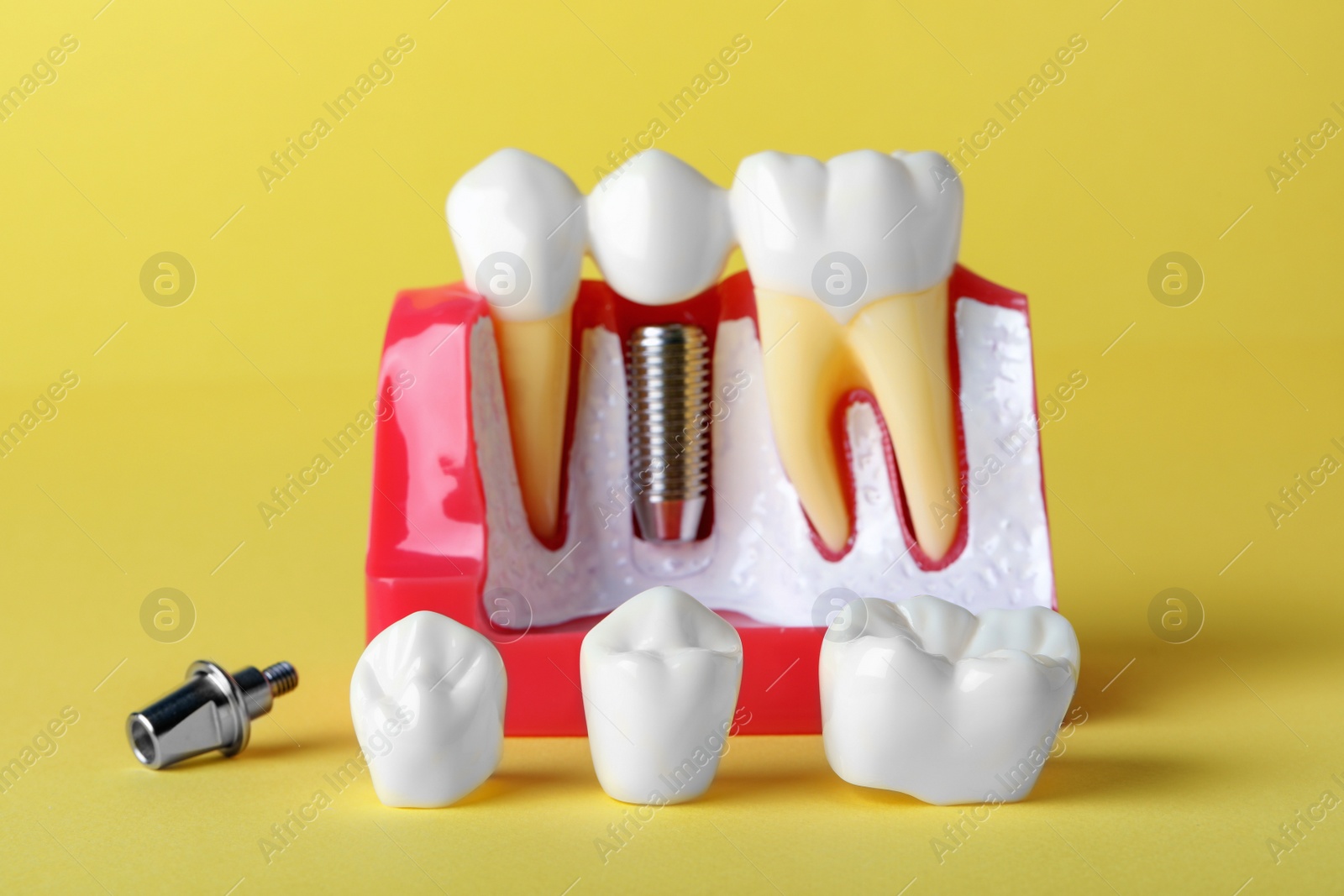 Photo of Educational model of gum with post and crown for dental implant between teeth on yellow background