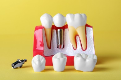 Educational model of gum with post and crown for dental implant between teeth on yellow background