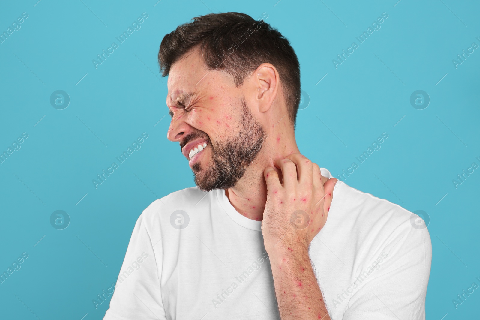 Photo of Man with rash suffering from monkeypox virus on light blue background