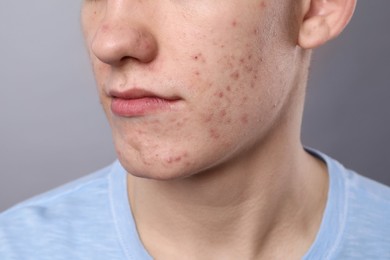 Young man with acne problem on grey background, closeup