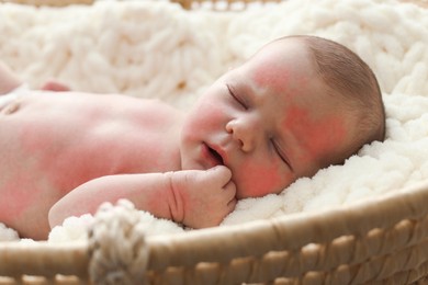 Cute little baby with allergic redness sleeping in soft cradle, closeup