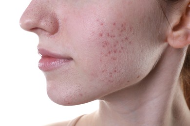 Photo of Young woman with acne problem on white background, closeup