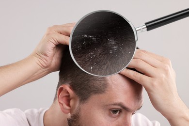 Image of Man suffering from dandruff on light grey background, closeup. View through magnifying glass on hair with flakes