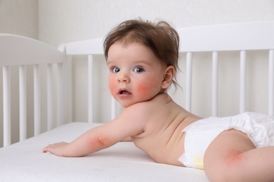 Cute little baby with allergic redness lying in crib at home