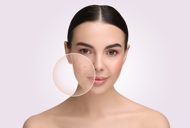 Woman with acne on her face on beige background. Zoomed area showing problem skin