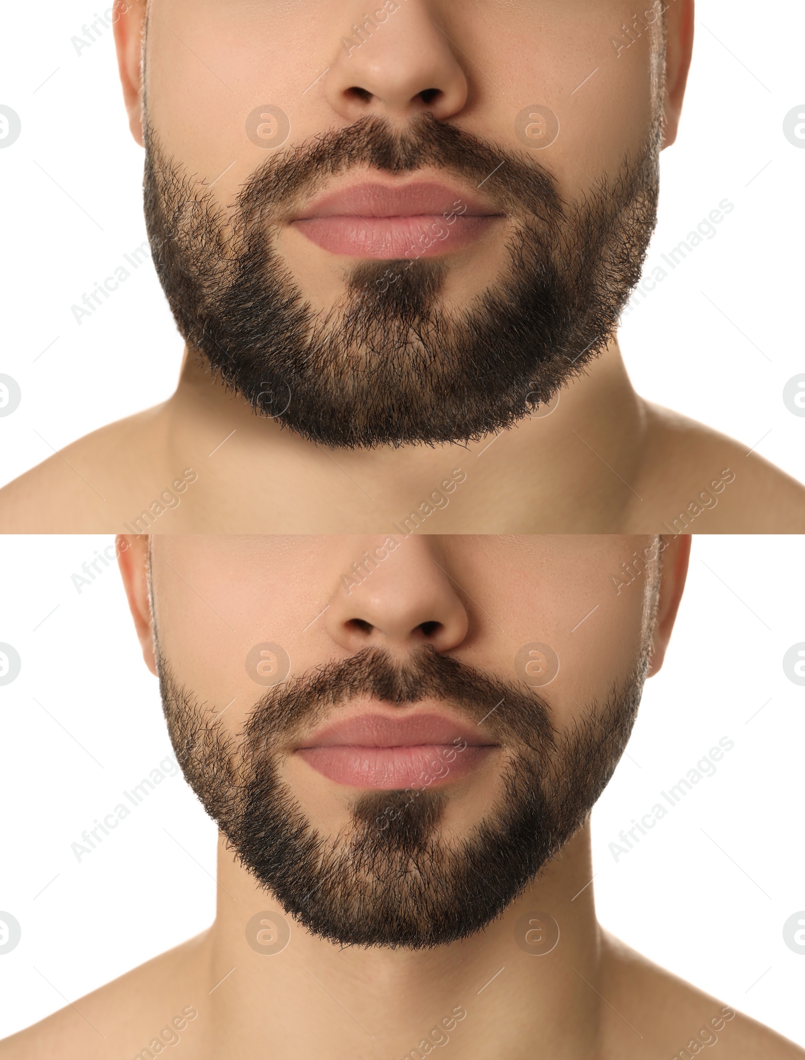 Image of Double chin problem. Collage with photos of man before and after plastic surgery procedure on white background, closeup