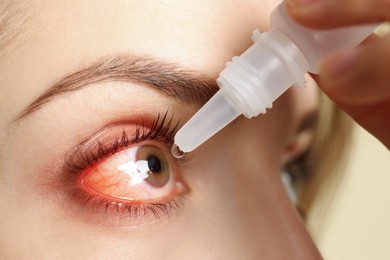 Closeup view of woman with inflamed eyes using drops