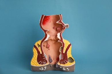 Photo of Anatomical model of rectum with hemorrhoids on light blue background
