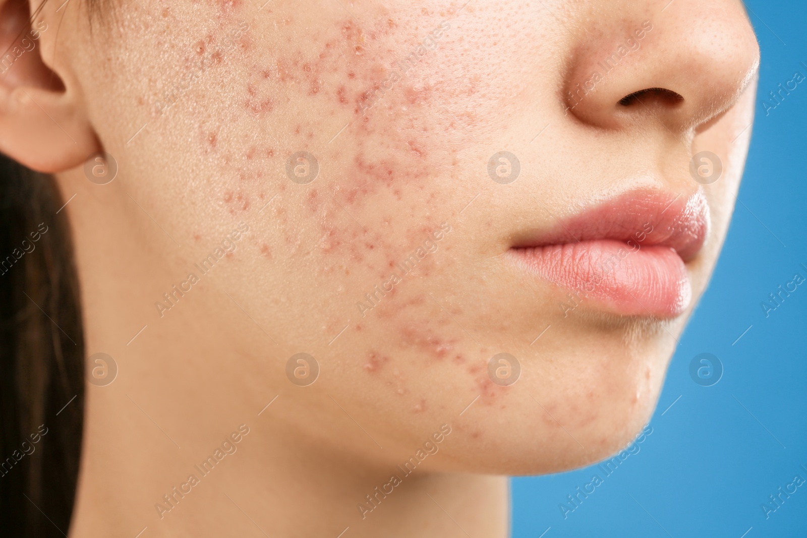 Photo of Teenage girl with acne problem on blue background, closeup