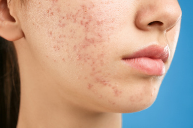 Photo of Teenage girl with acne problem on blue background, closeup